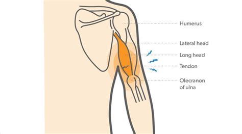 tricep strain recovery time